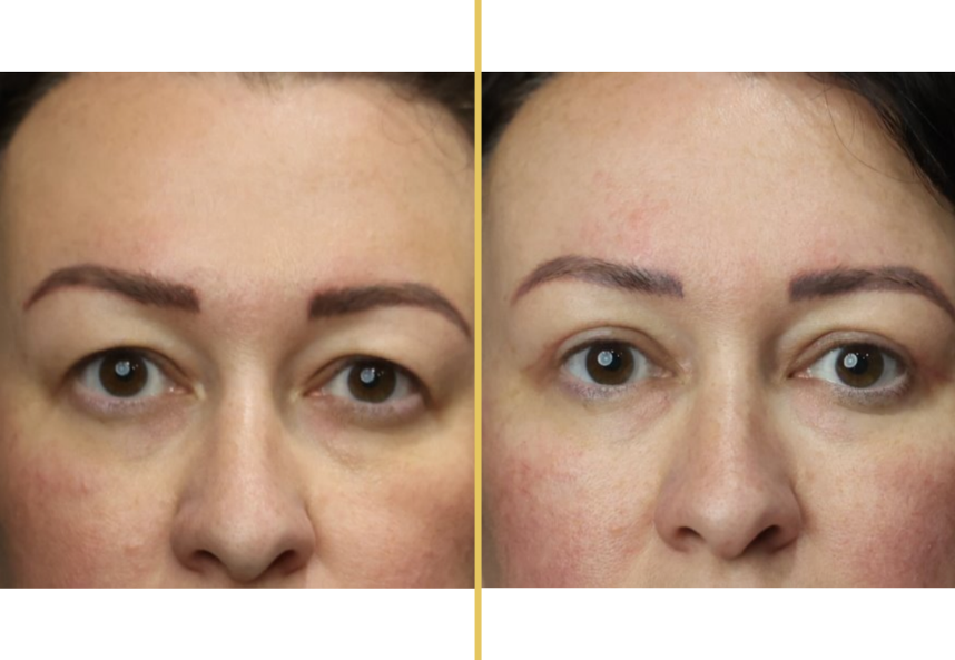 Before and after photo of an Illuum Cosmetic Surgery patient – Case 1041