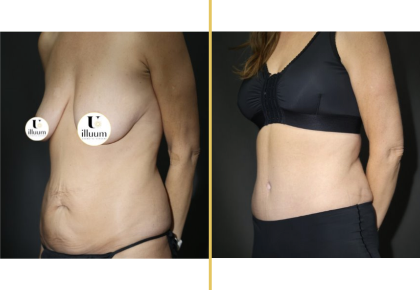 Before and after breast surgery results showing improved contour and abdominal definition