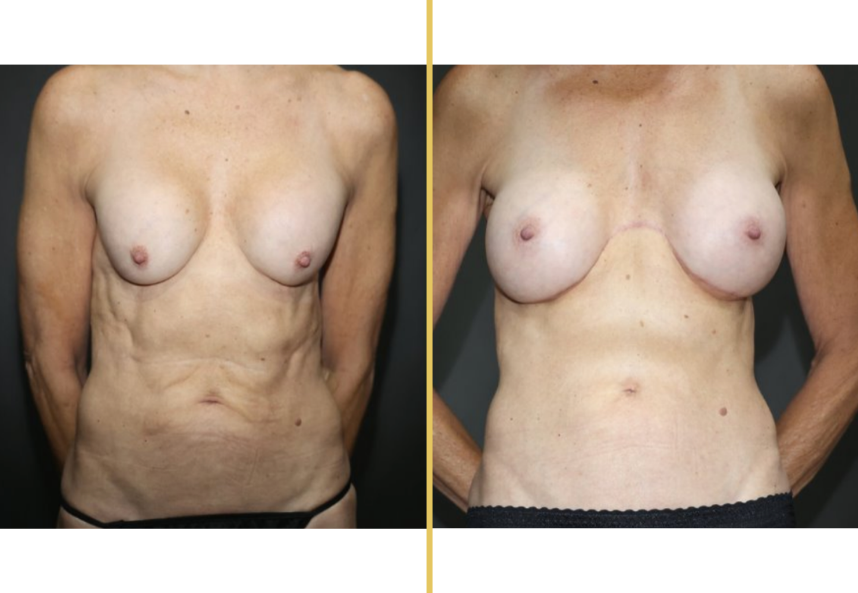 Breast augmentation before and after comparison, frontal view