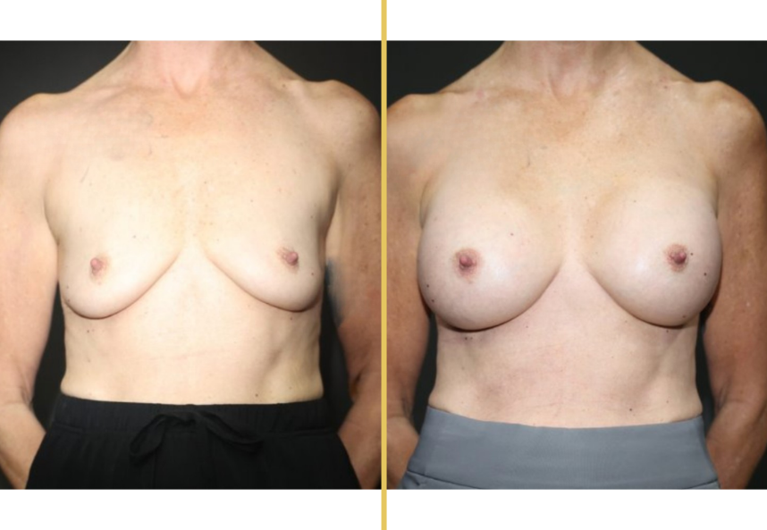 Before and after photo of an Illuum Cosmetic Surgery patient – Case 1043