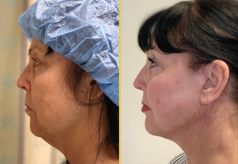 facelift female69 main