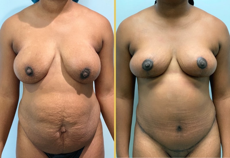 mommy makeover 1 main