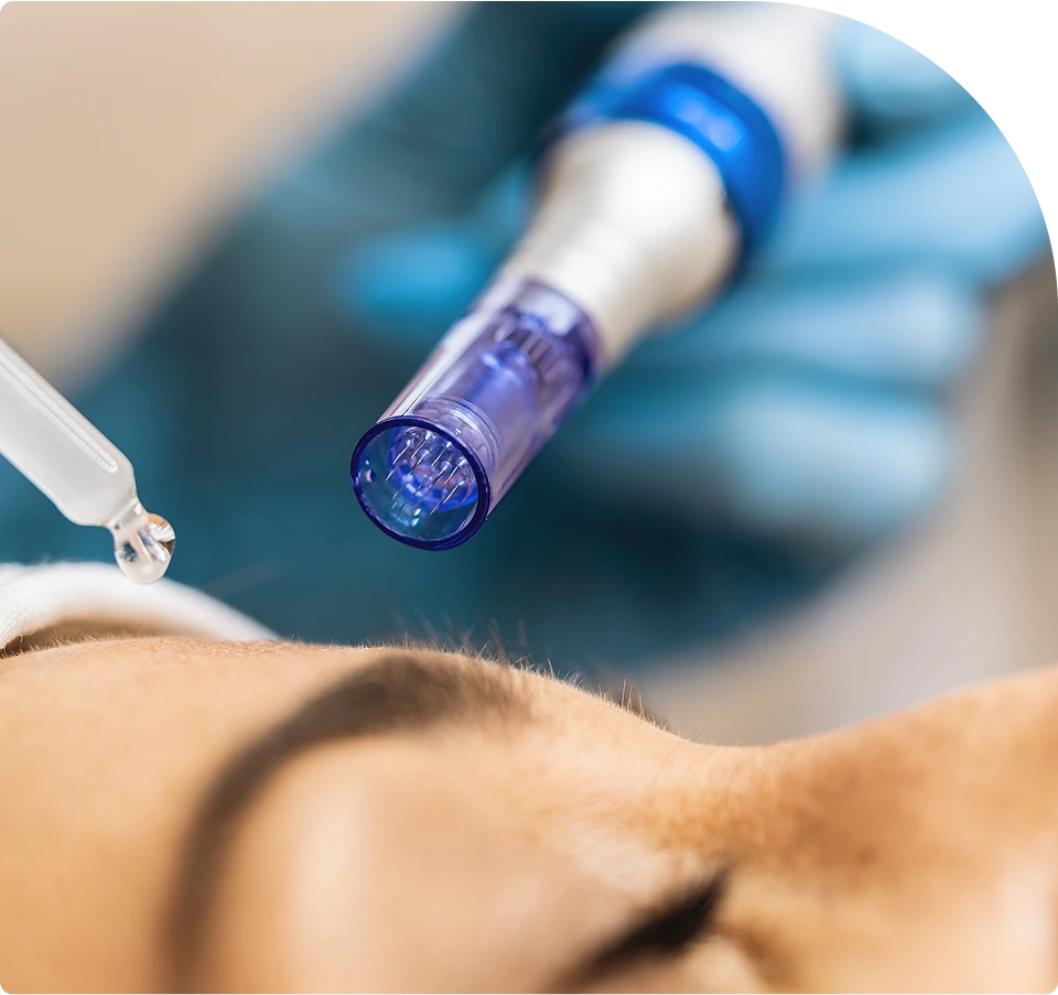 How Does Microneedling Dermapen NYC Work? Banner