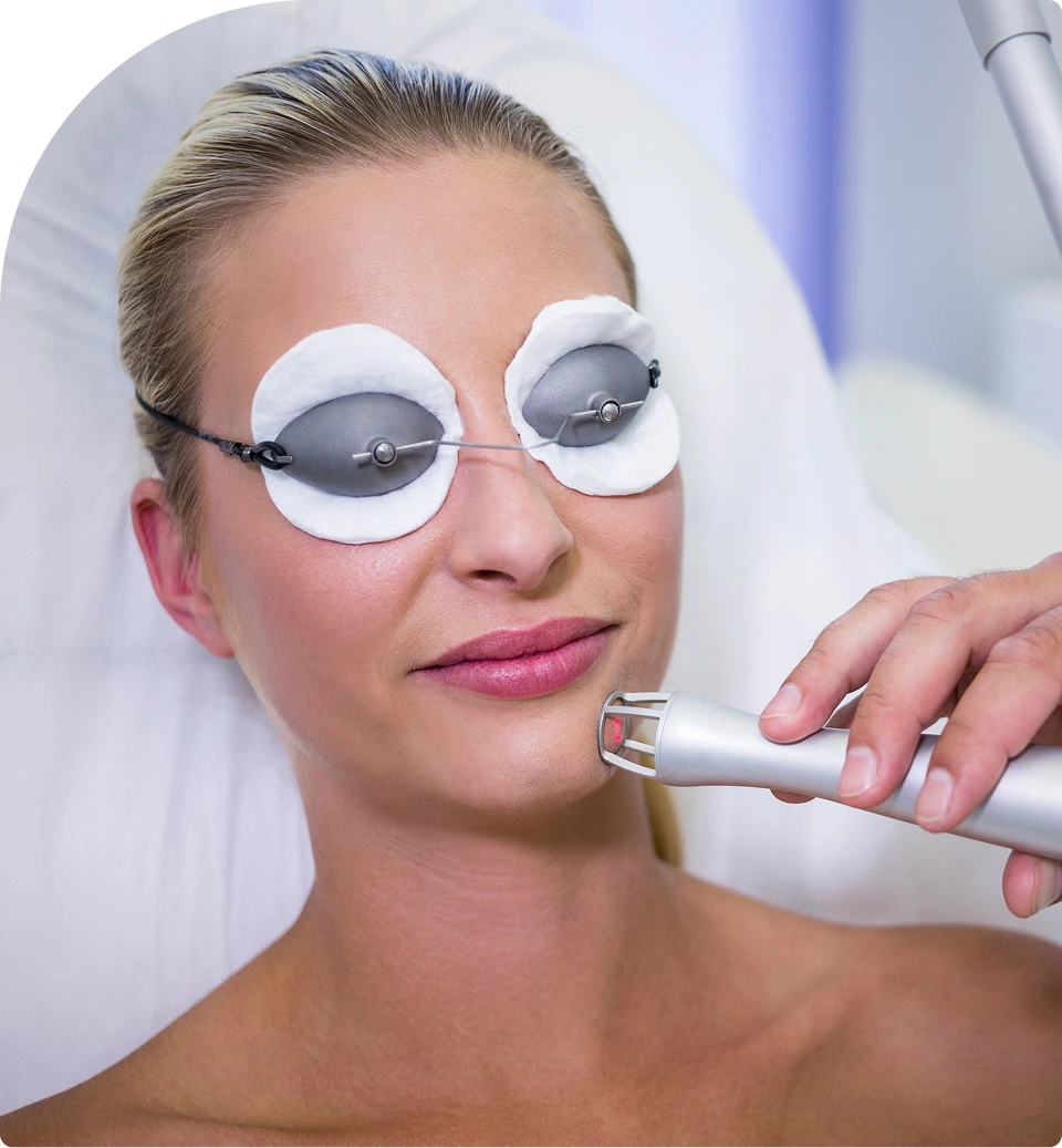 Patient wearing protective eyewear receiving CO2 laser resurfacing treatment to the face