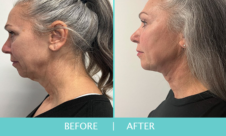 Jax-Body-Chin-Liposuction-2-1_1