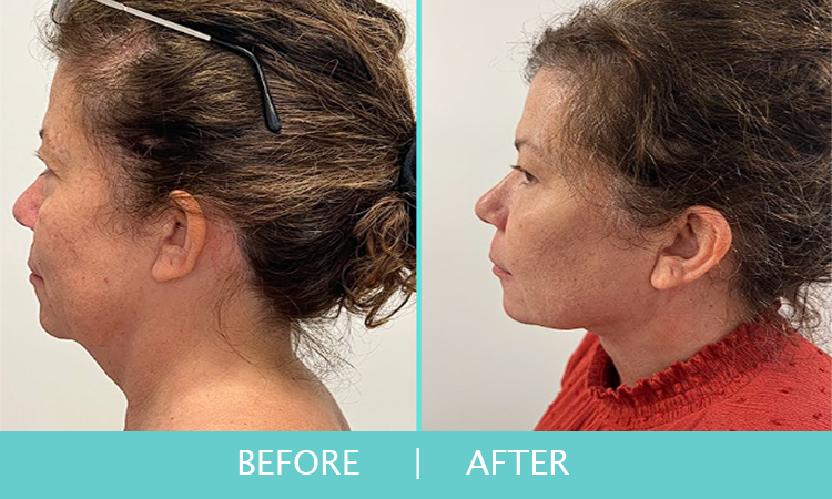 Jax-Body-Chin-Liposuction-3_1