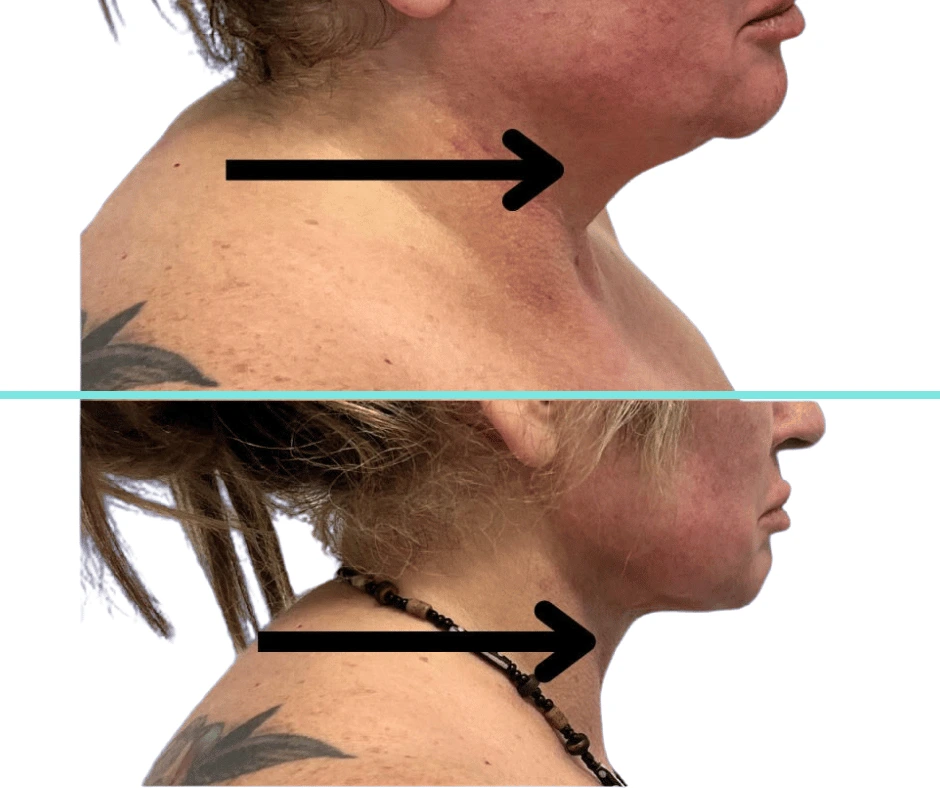 Neck transformation with Gentle Sculpt