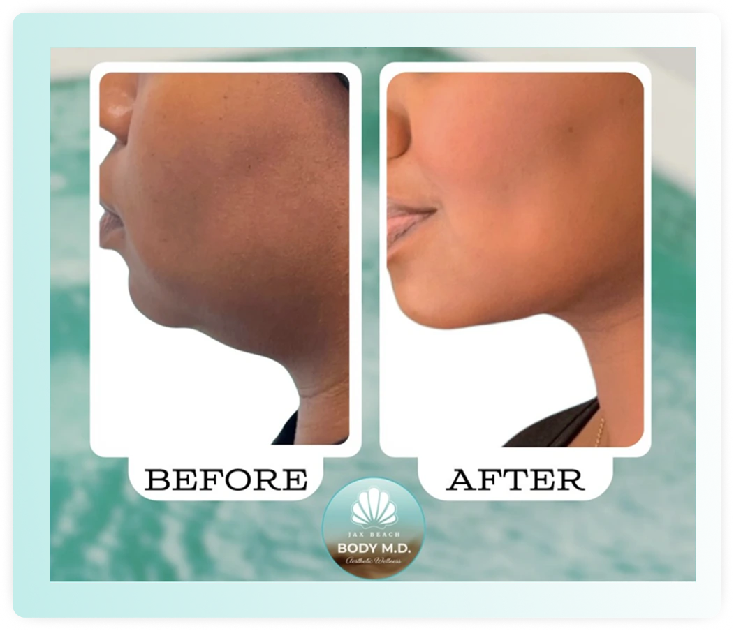 Before and after profile views showing facial contouring results