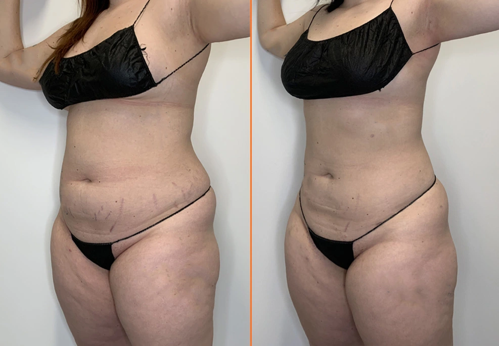 Lipo 360 Case oblique