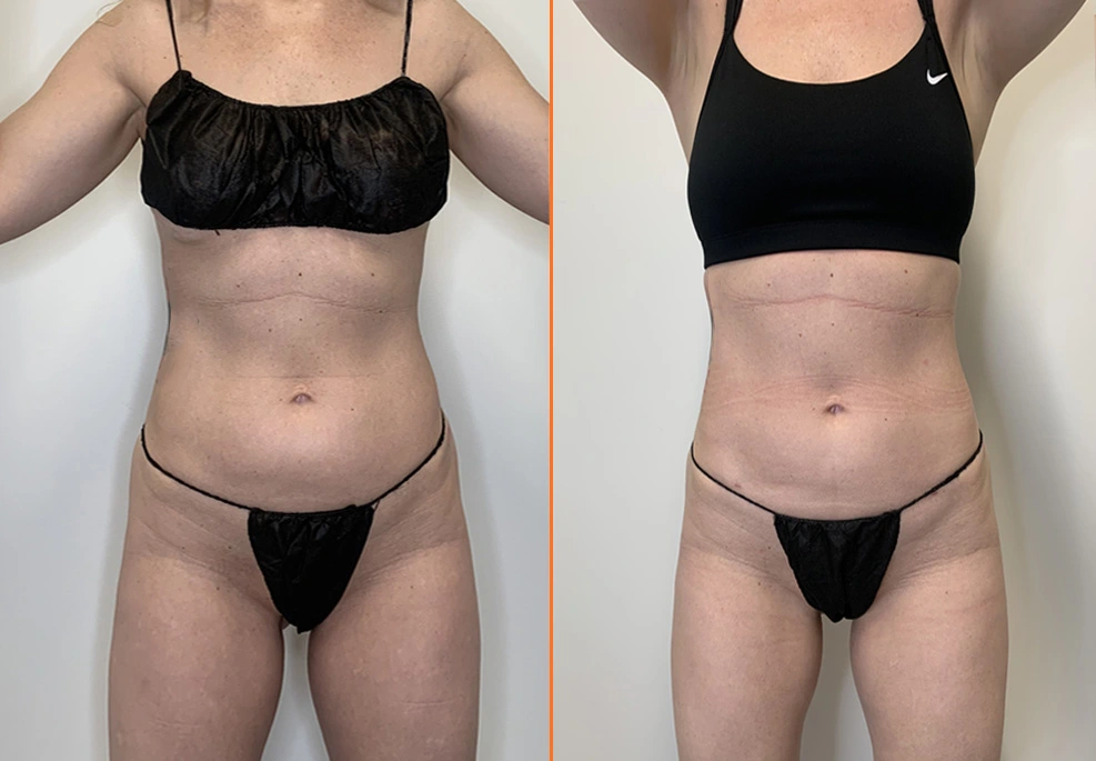 Abdominal Liposuction Case-front