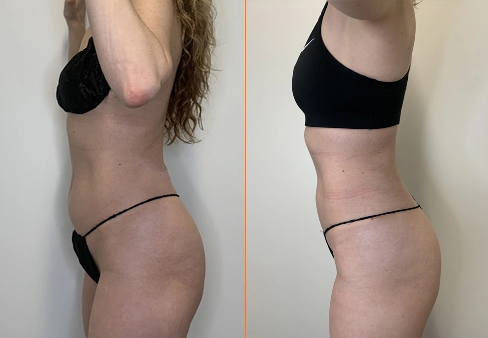 Abdominal Liposuction side