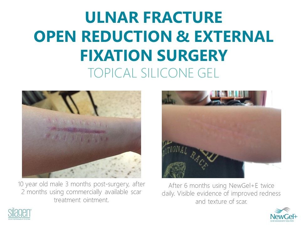 Silagen Rapid Recovery Scar System