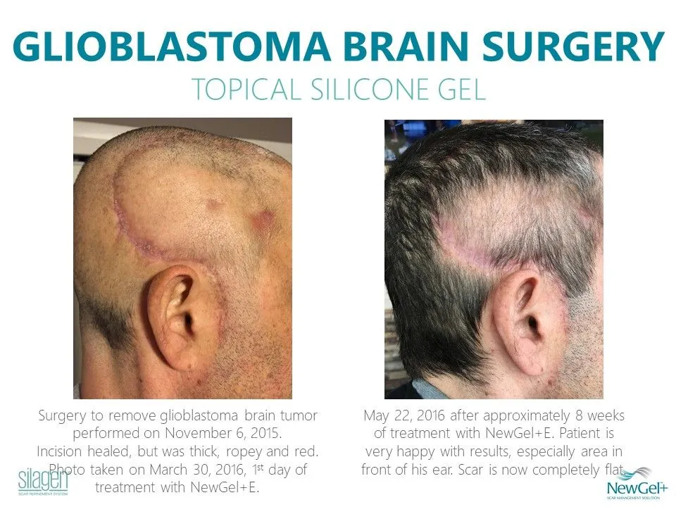 Silagen Rapid Recovery Scar System