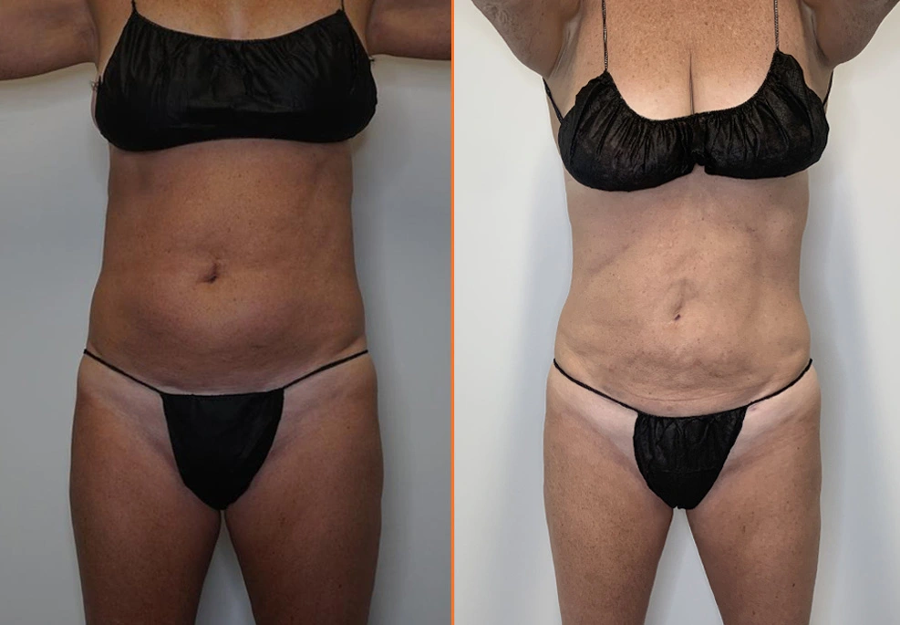 Abdominal Liposuction Case 14Front