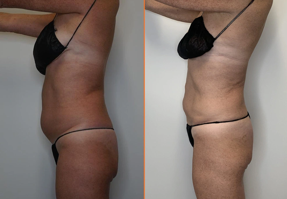 Abdominal Liposuction Case -side