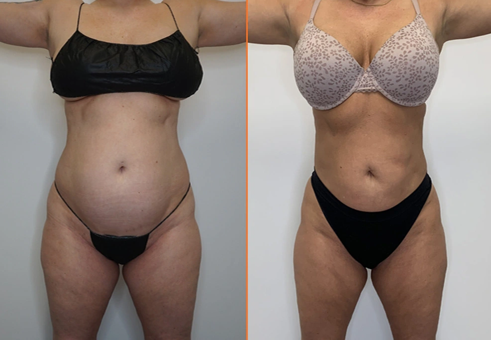 Abdominal Liposuction Case-Front.