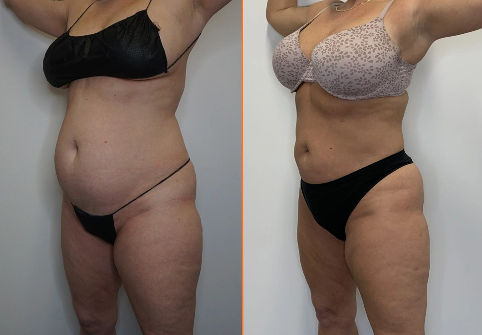 Abdominal Liposuction Case -oblique