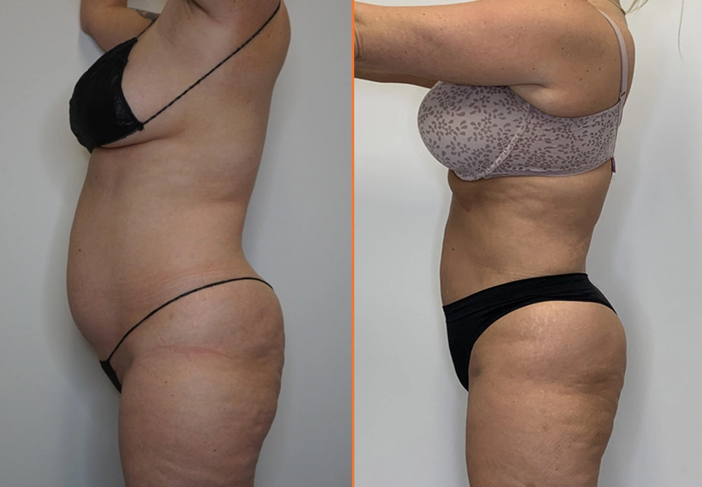 Abdominal Liposuction Case-side