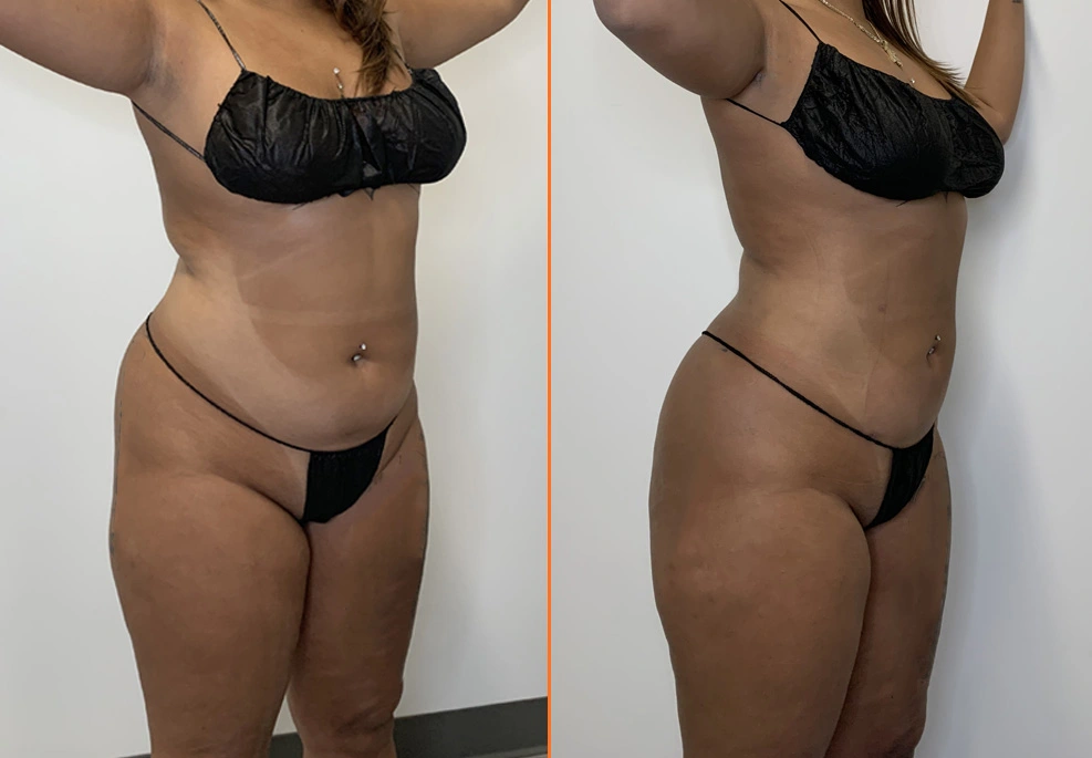 Lipo 360 Case -oblique female