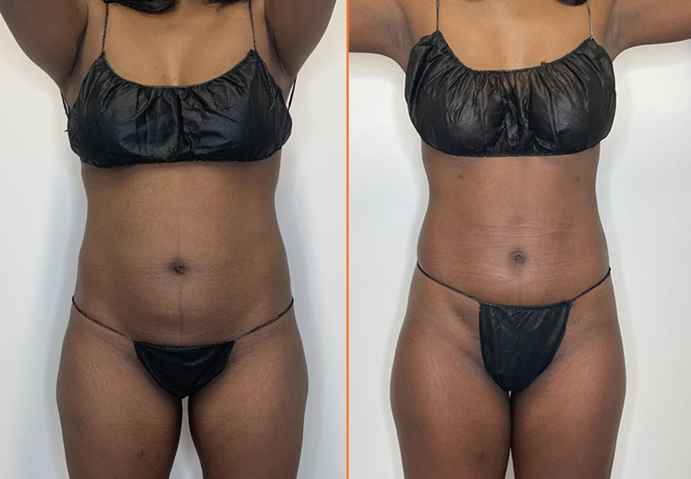 Lipo 360 Case 03 Front