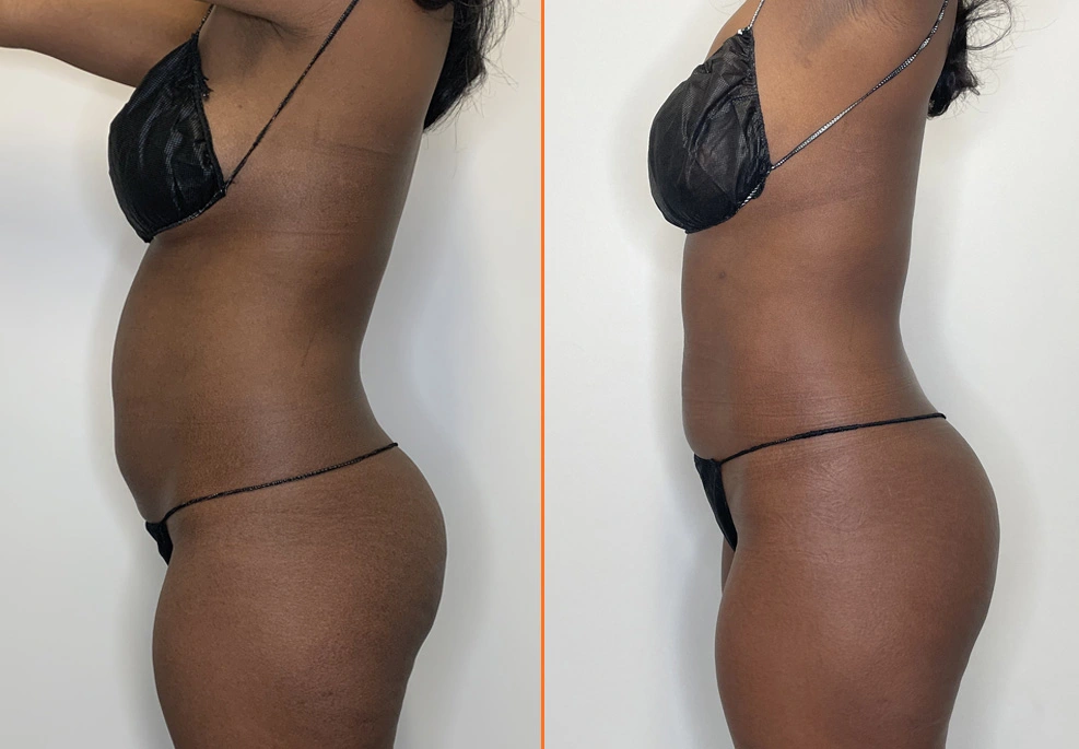 Lipo 360 Case 03 Side