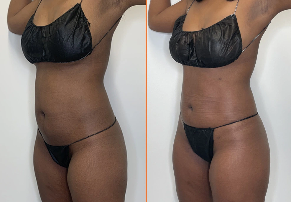 Lipo 360 Case 03 oblique