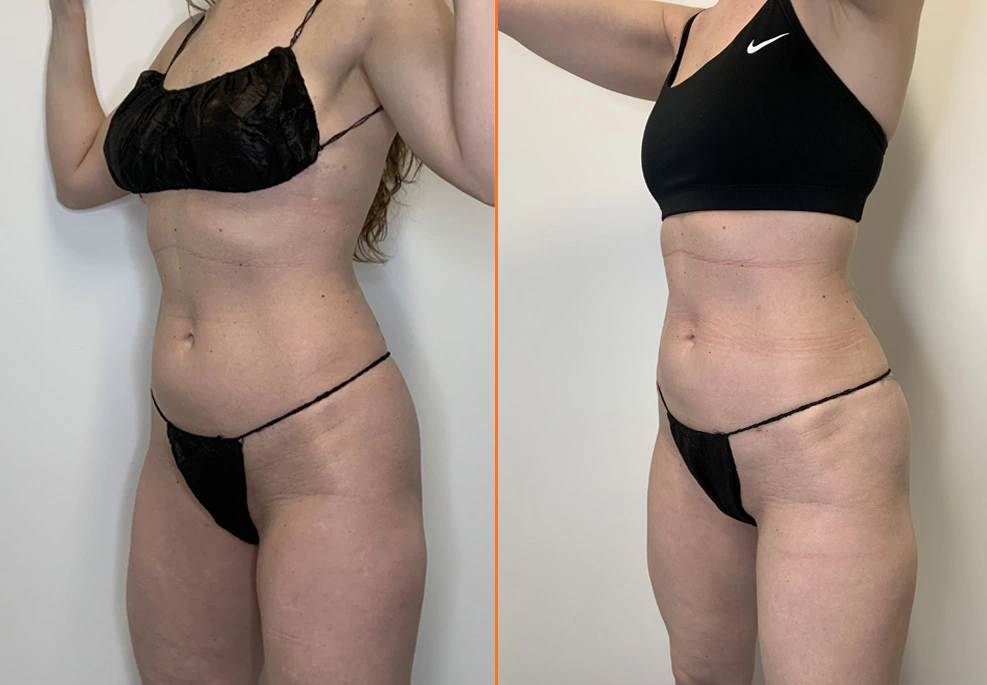 Abdominal Liposuction-oblique