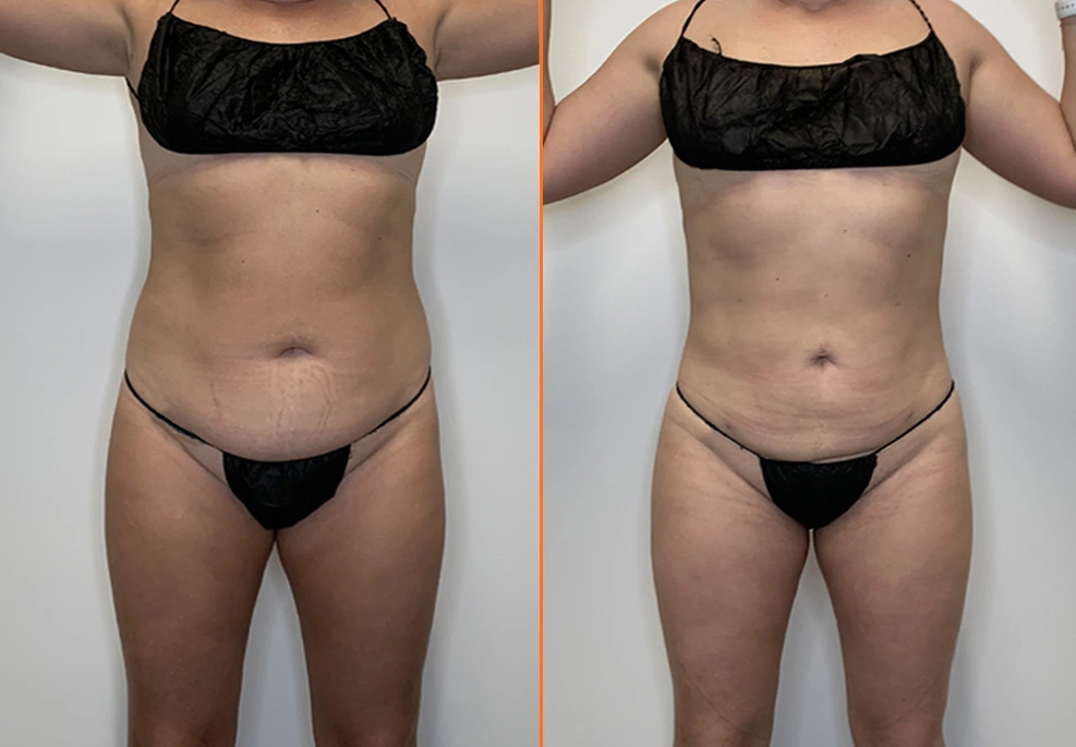 Lipo 360 Case 24 front