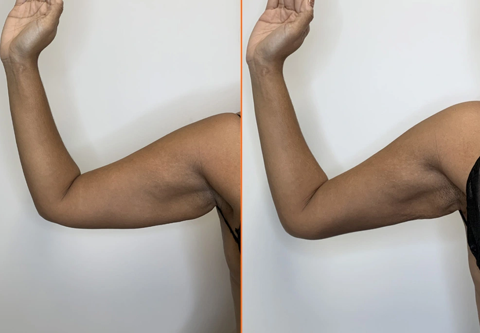 Arm Liposuction 1