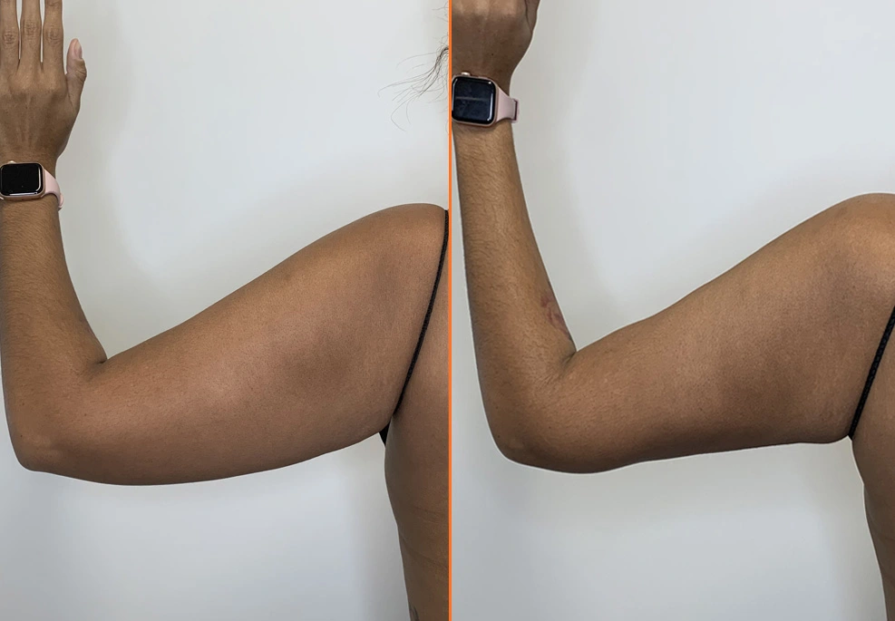 Arm Liposuction 3
