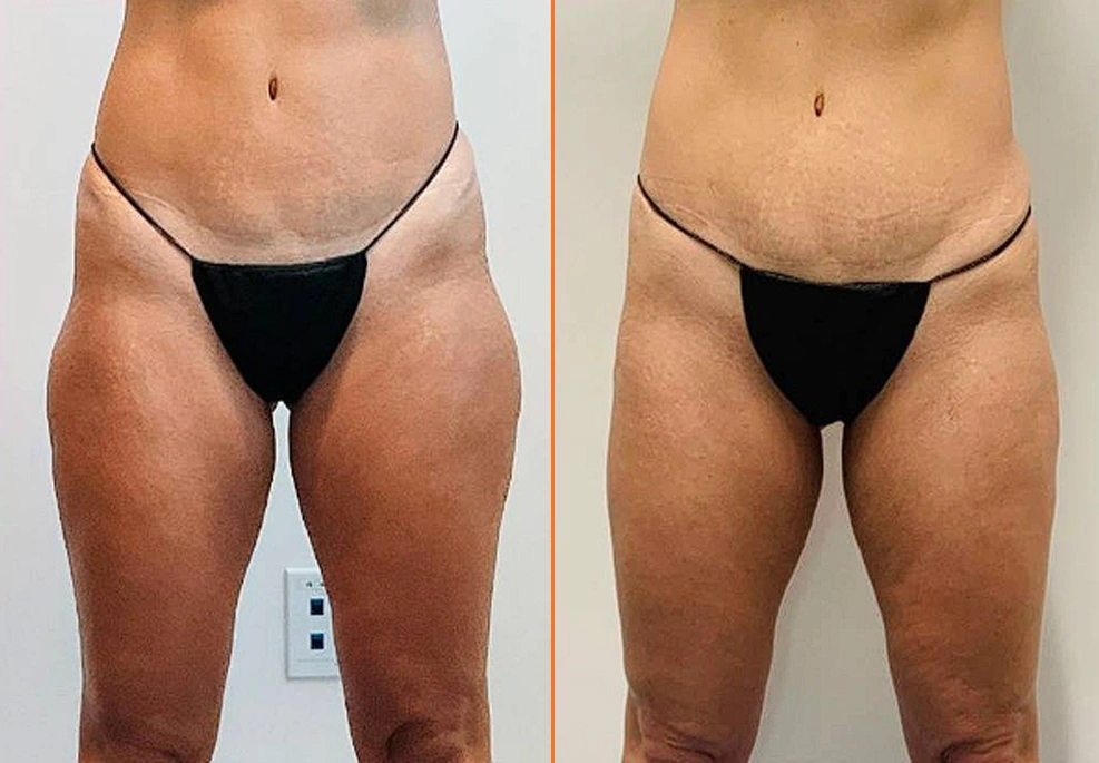 Outer Thigh Liposuction