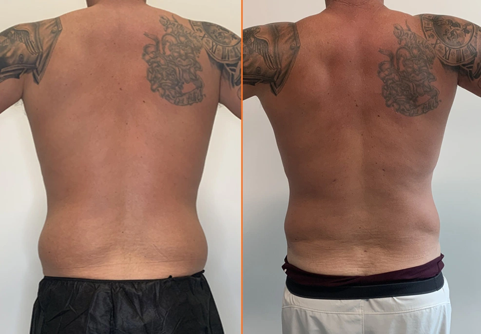 Lipo 360 Case 04 back