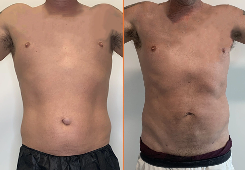 Lipo 360 Case 04 front