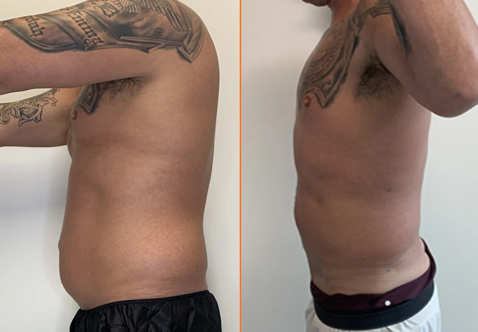 Lipo 360 Case 04 side