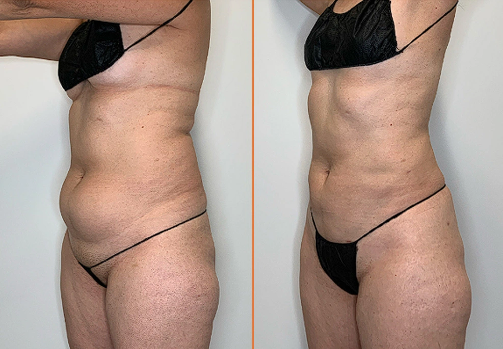 Lipo 360 Case 06 Oblique 2