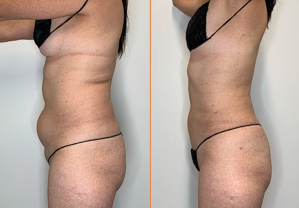 Lipo 360 Case 06 Side 2