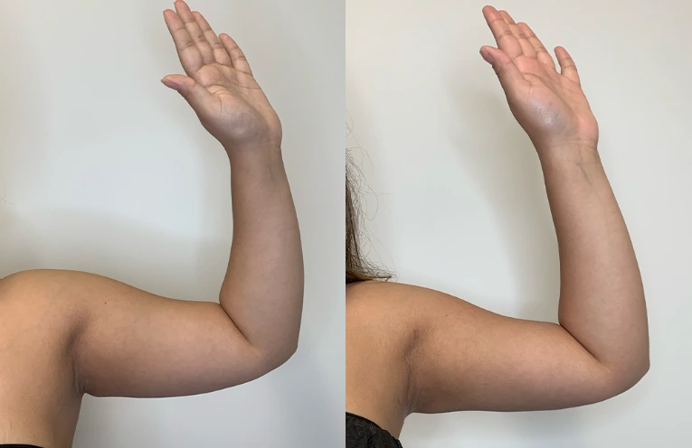 Arm Liposuction Case 8