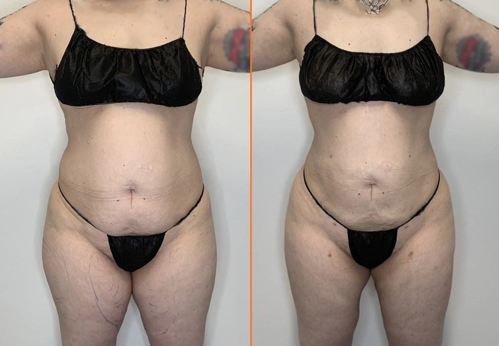 Lipo 360 Case 07 Frony