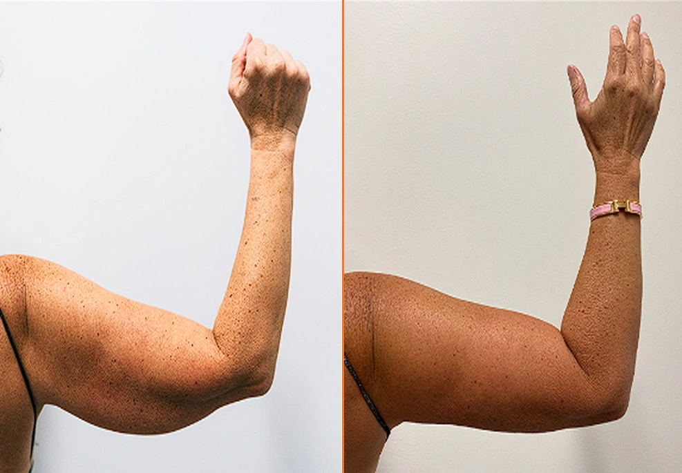 Arm Liposuction H 1