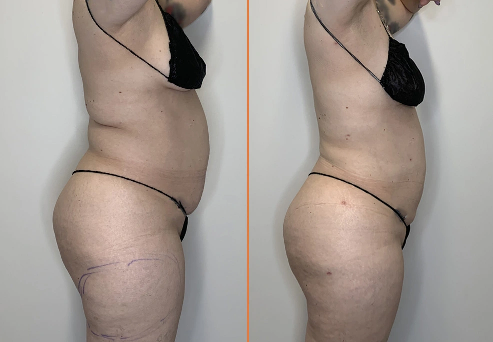 Lipo 360 Case 07 side