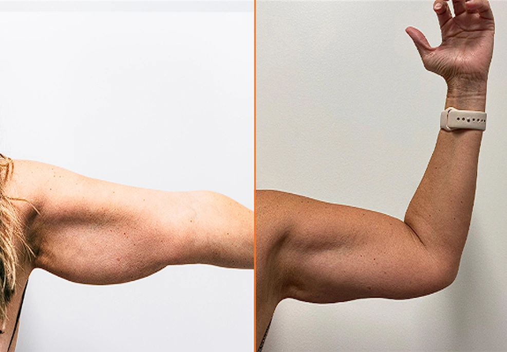 Arm Liposuction h2