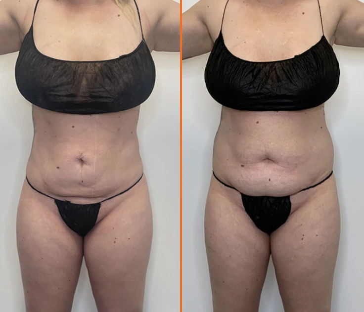 what is minimally invasive liposuction? banner