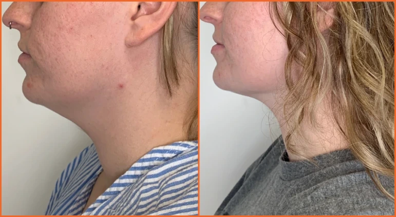Chin Liposuction Before And After Results Banner