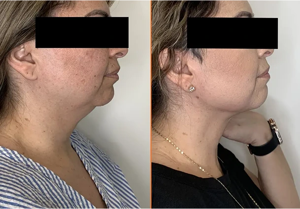 Chin Liposuction Before & After Banner