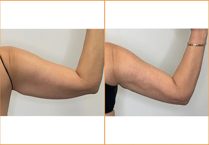 View our Arm Liposuction results Banner