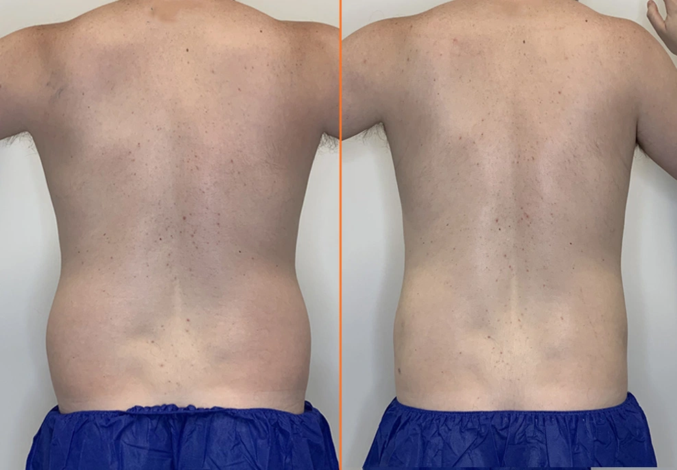 Lipo 360 Case 05 Back