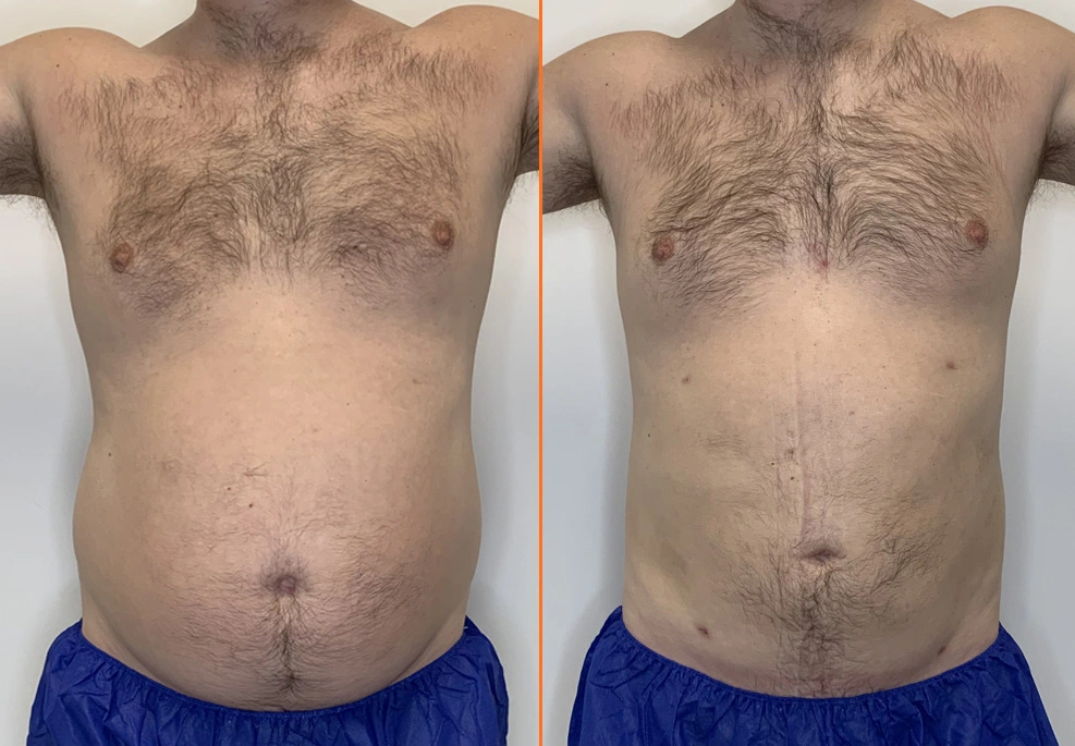 Lipo 360 Case 05 Front