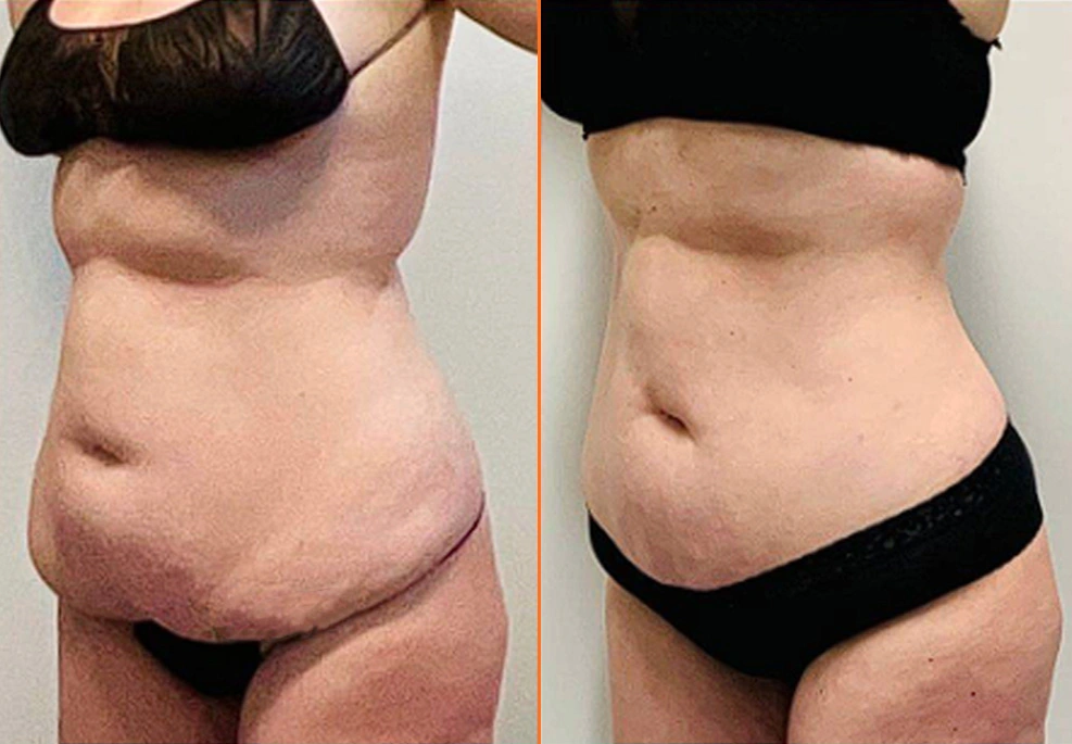 Abdominal Liposuction