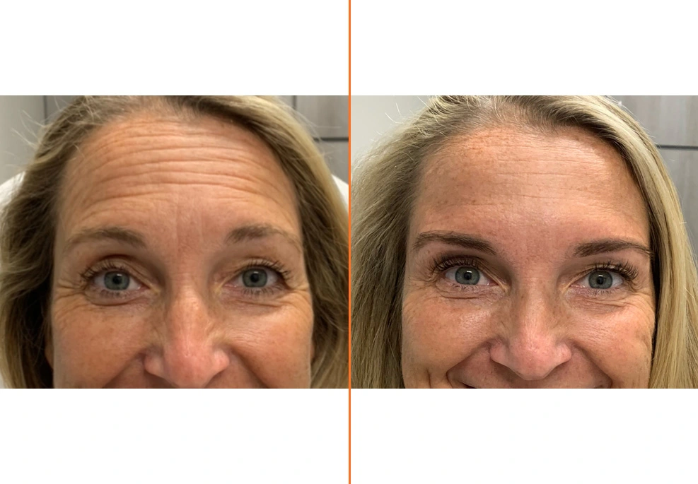 Dysport old female face