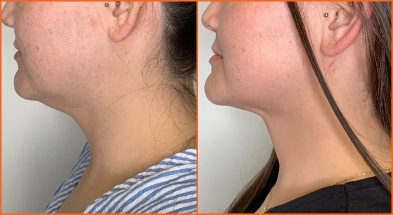 Chin Liposuction Before And After Results Banner